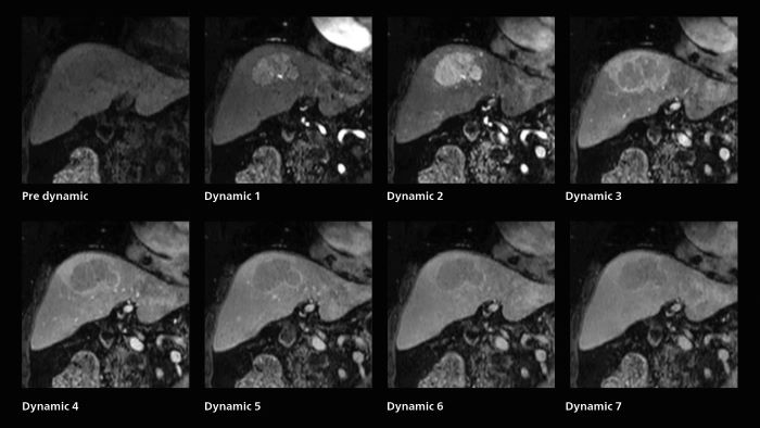 Fast dynamic liver MRI: volume dynamic study of 1.05 min, 1.6 x 1.8 x 2.0 mm, 200 slices
