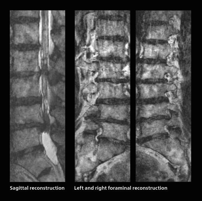 Fast lumbar spine MRI with SmartSpeed of a patient in pain produced a successful isotropic diagnostic scan in only 94 minutes, mobile two