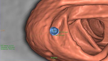 ct virtual colonoscopy