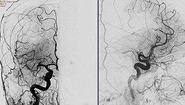 xa vascular processing
